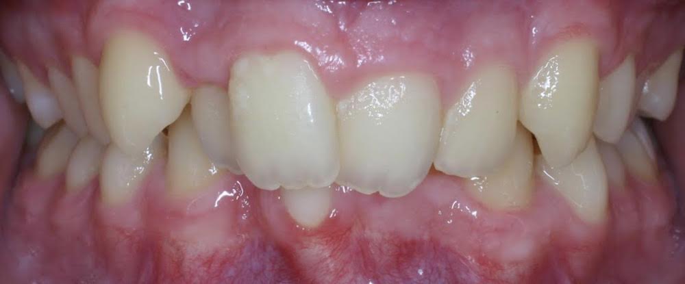 Closeup of smile with crowding and deep bite
