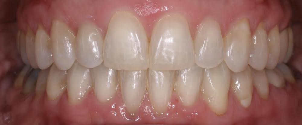 Closeup of flawless smile after orthodontics