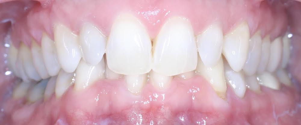 Closeup of crowded smile with deep bite