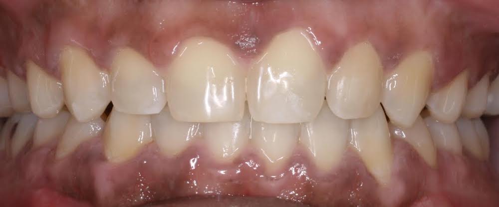 Perfectly aligned smile after orthodontics