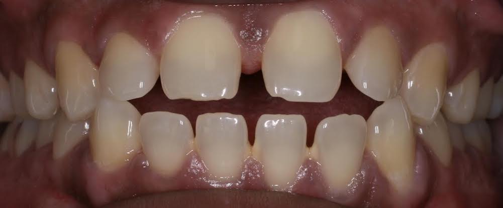 Closeup of smile with open bite protruding front teeth and spacing concerns