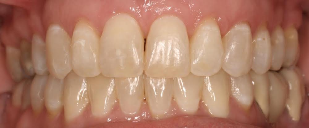 Closeup of healthy smile after orthodontics