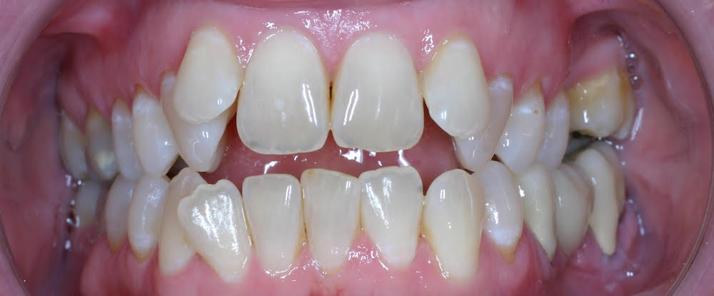 Closeup of smile with numerous bite alignment concerns