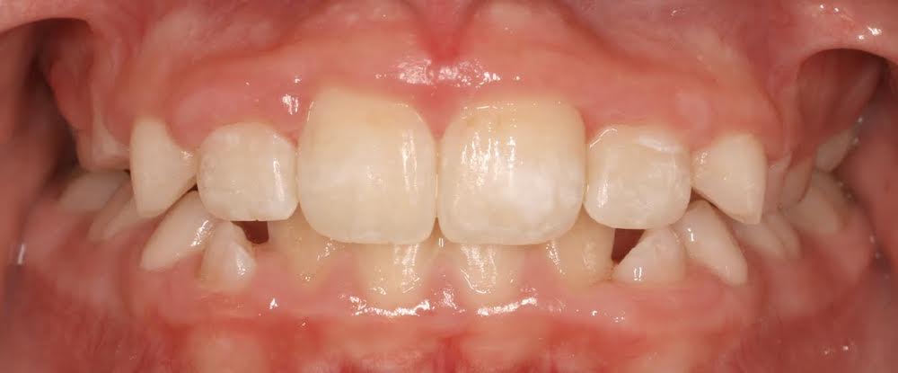 Closeup of beautifully aligned smile