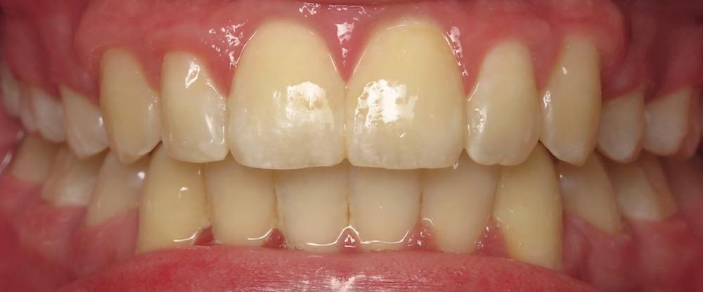 Closeup of perfectly aligned smile