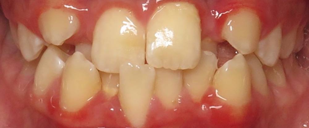 Closeup of smile with anterior crossbite and crowding