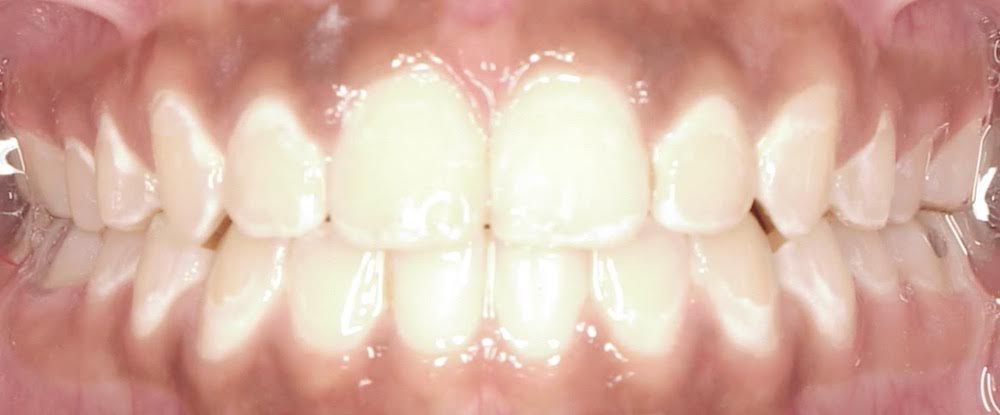 Closeup of flawlessly aligned smile