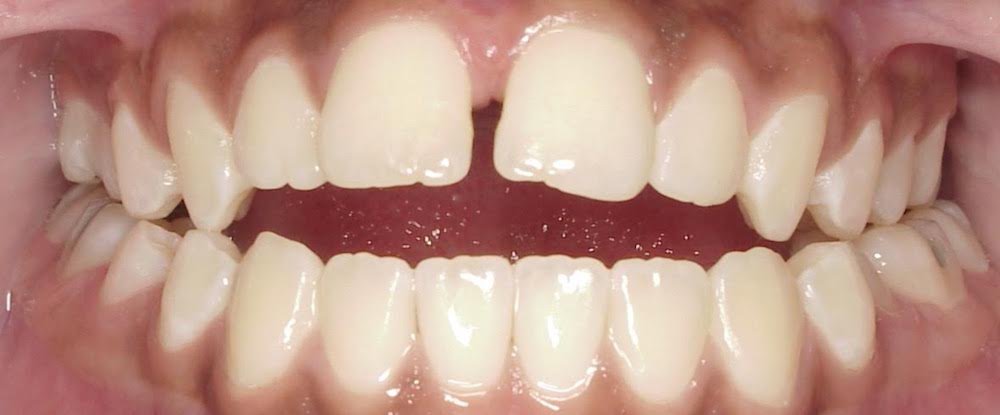 Closeup of smile with open bite spacing and posterior crossbite