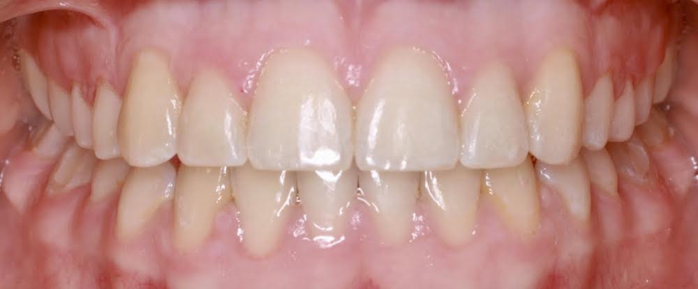 Closeup of beautiful smile after orthodontic treatment