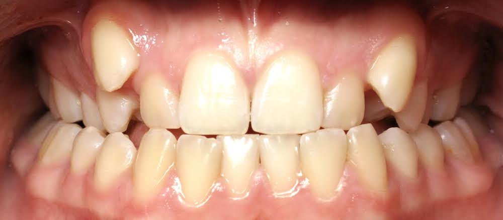 Closeup of smile with front and back crossbite crowding and blocked canines