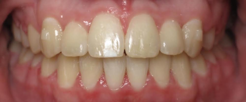 Closeup of gorgeous smile after orthodontic treatment