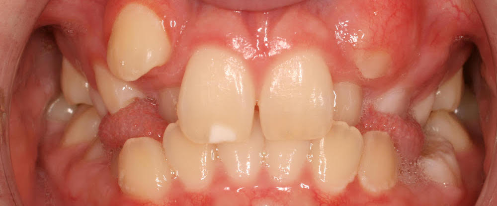 Closeup of smile with front and back crossbite crowding and impacted canines