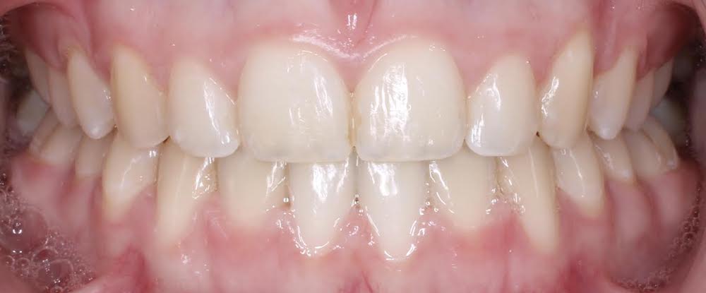 Closeup of perfected smile after orthodontics