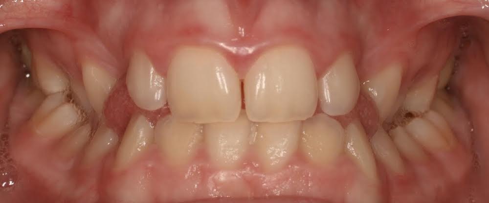 Closeup of smile with back crossbite crowding and blocked canines