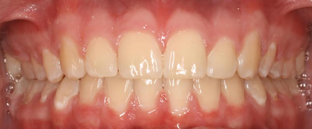 Closeup of properly aligned teeth after orthodontics