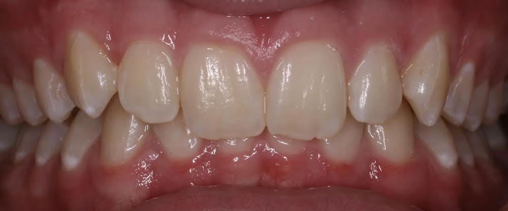 Closeup of smile with deep bite and teeth crowding