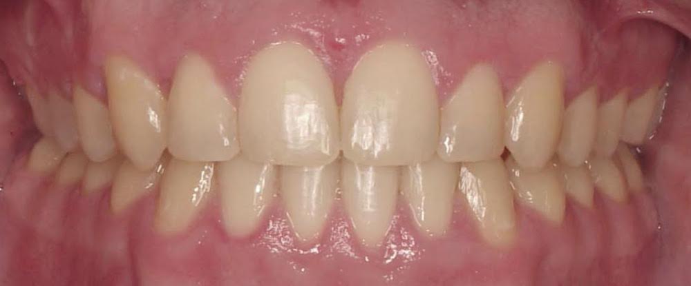 Perfect smile after orthodontics