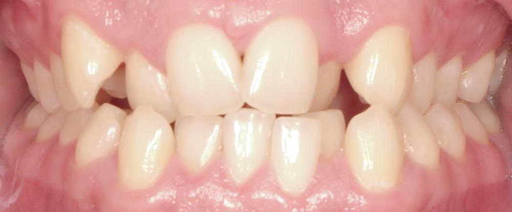 Closeup of smile crossbite crowding and bite misalignment