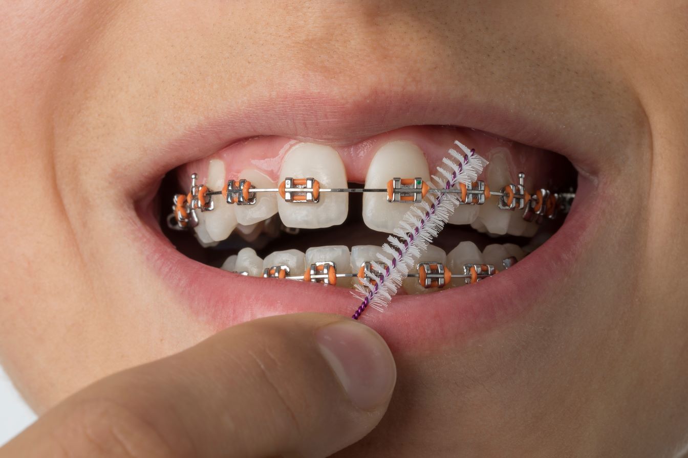 What to Include in a Braces Care Kit | Dr. Bradley Buchwald
